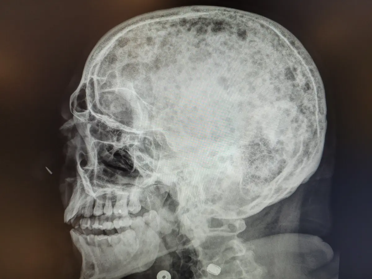 An x-ray image shows a human skull from the side, revealing the bone structure and teeth. Overlaid text reads 'my brain is…