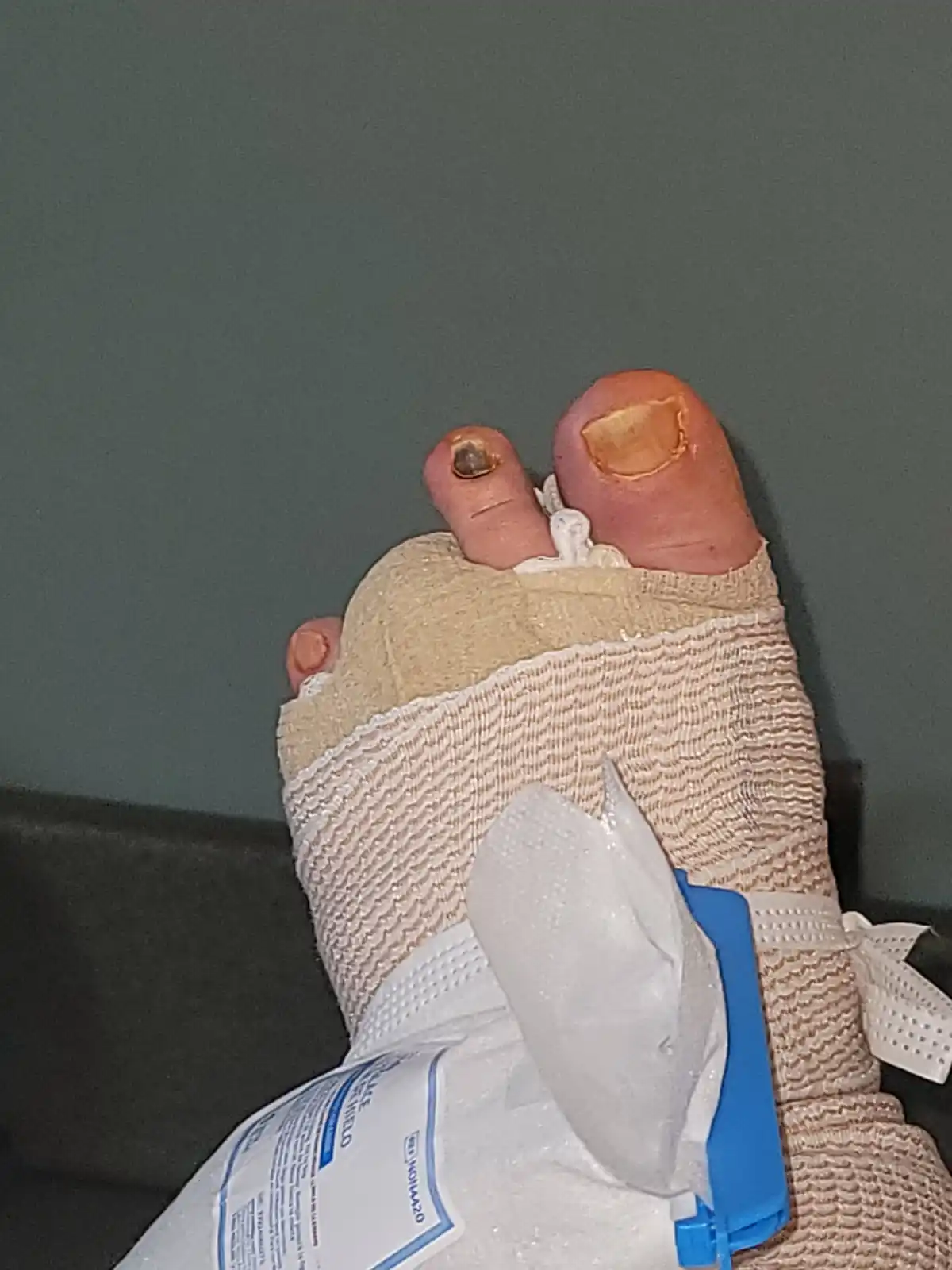 A close-up photo shows a person's foot with severe, raw, and inflamed toenail injuries on both big toes, wrapped in beige…