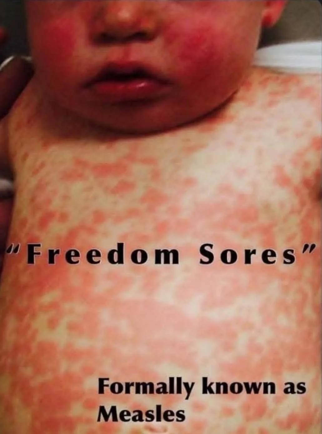 A close-up photo of a baby's torso and face, showing widespread red, blotchy rash across the chest and cheeks. Overlaid text…