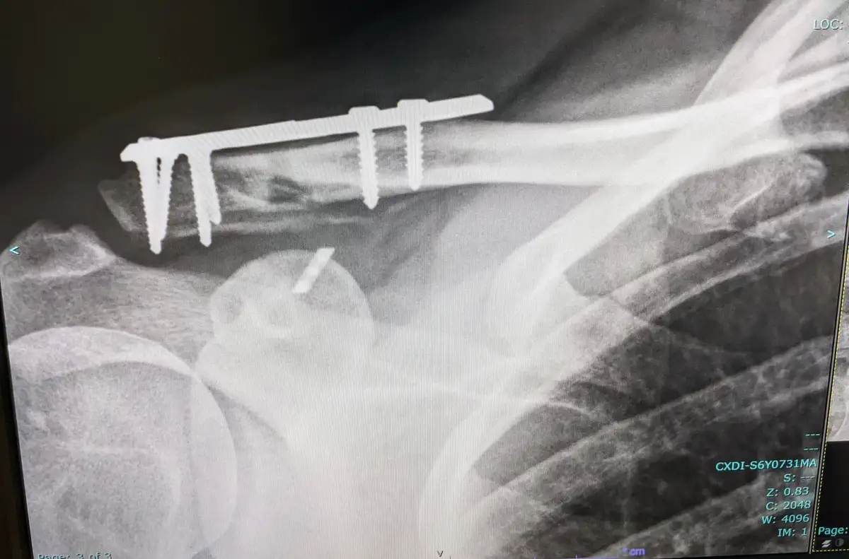 A black-and-white x-ray image shows a metal plate and screws implanted in a human arm bone, with surrounding bone structures…
