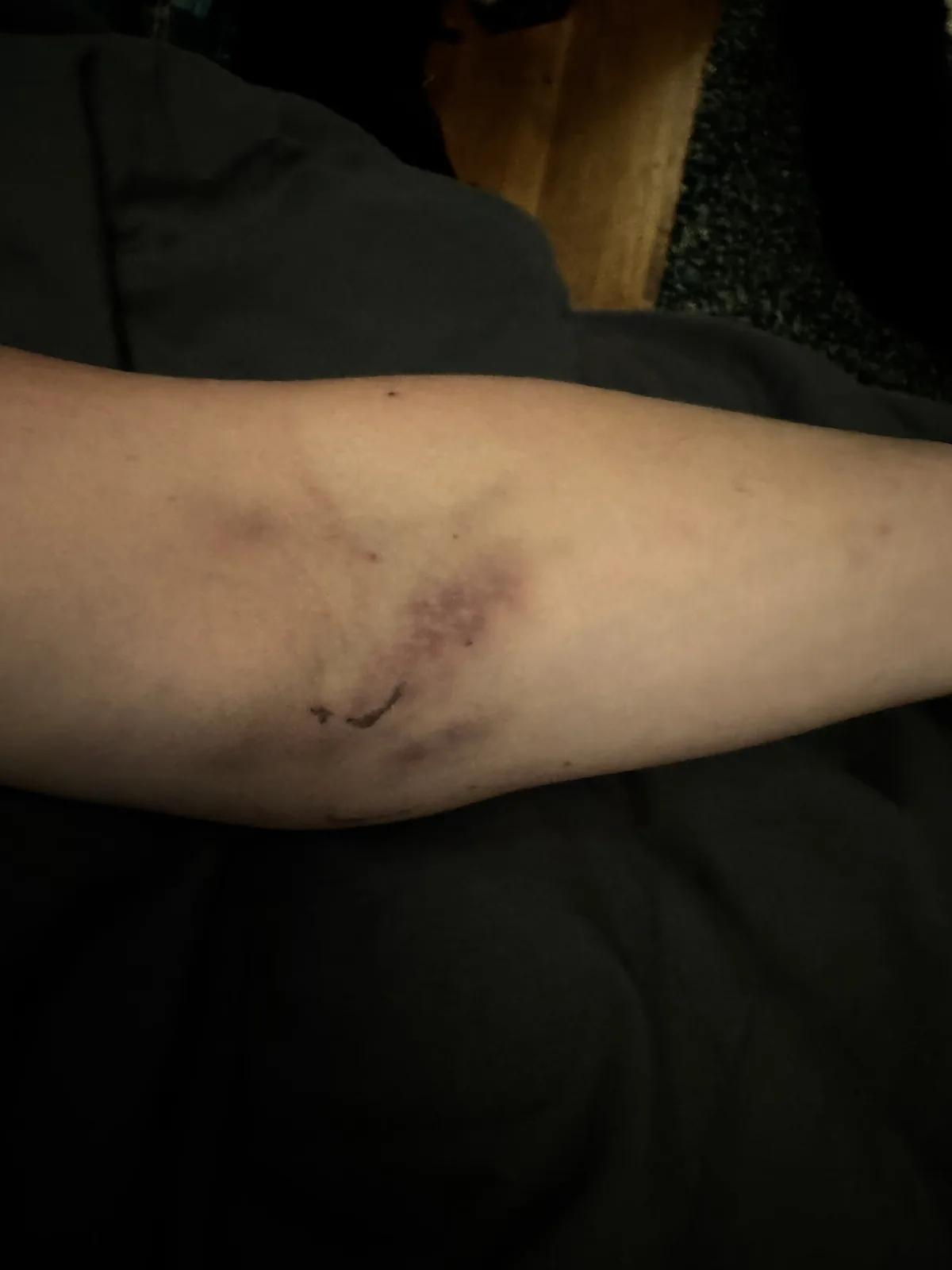 A close-up photo shows a person's forearm with a large, dark bruise and a small, crude smiley face drawn in black marker on…