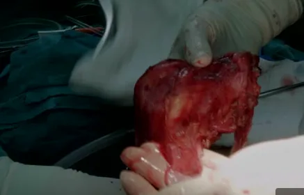 A close-up shot shows gloved hands holding a raw, bloody, and visibly damaged human heart during what appears to be a…