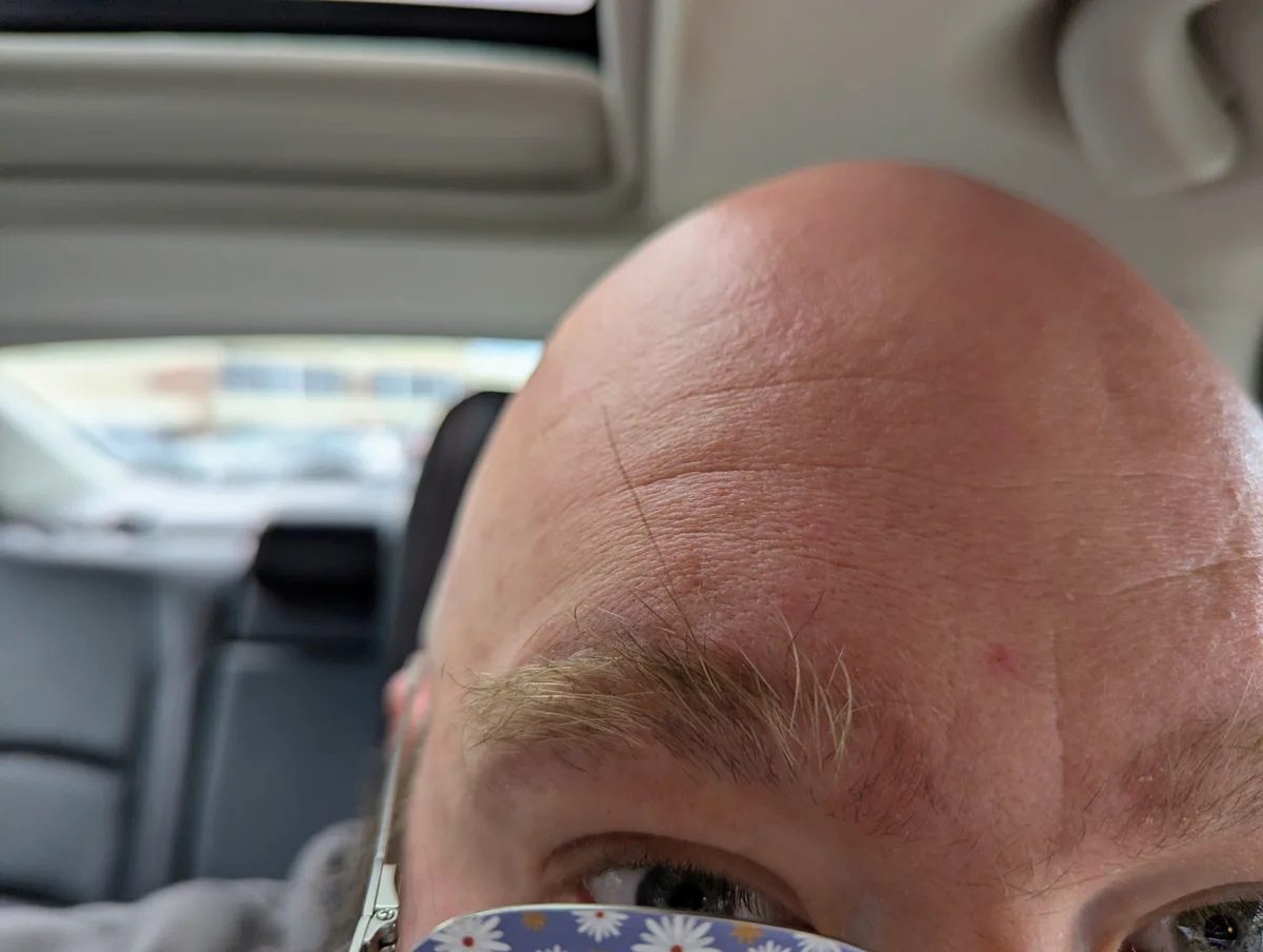 A close-up photo shows the top of a bald man's head inside a car, with a single thin hair visible on his scalp and a small…