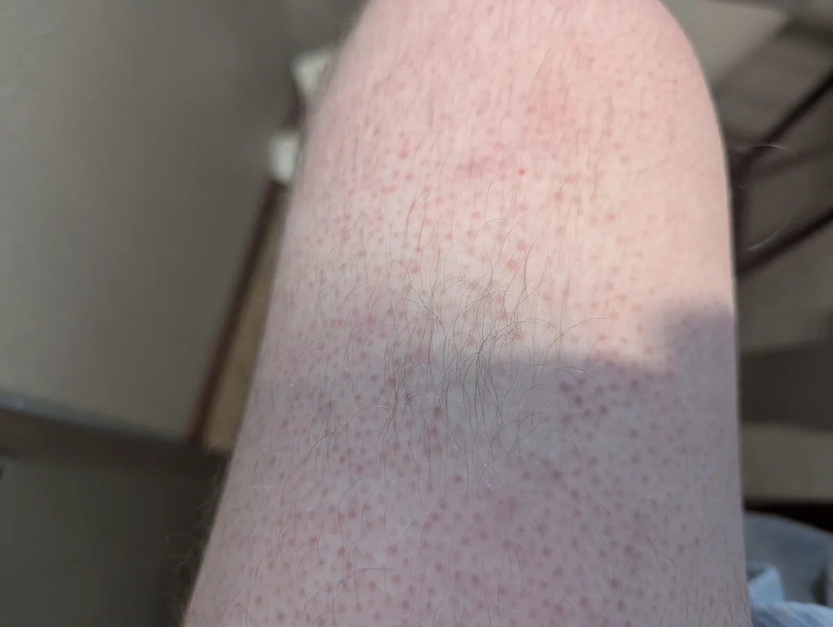A close-up photo shows a person's hairy leg covered in numerous small, red, raised dots consistent with mosquito bites. The…