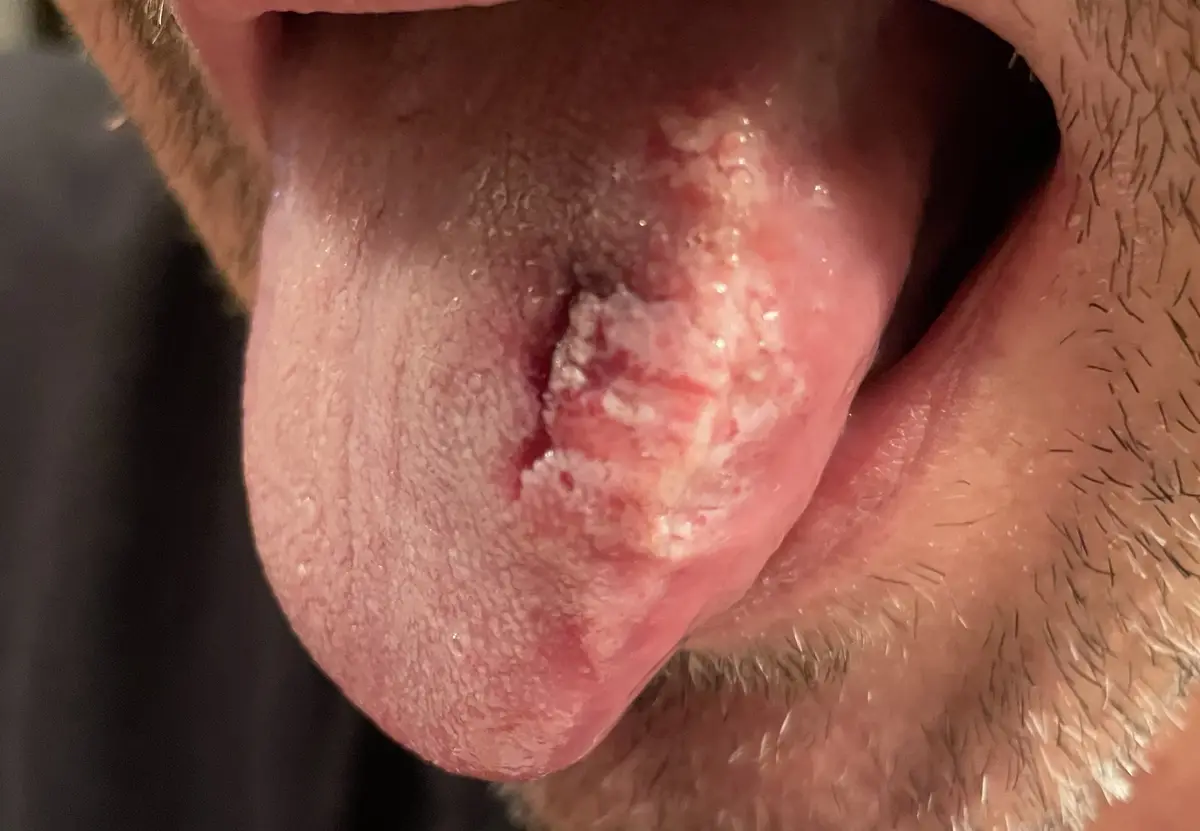 A close-up photo shows a person's tongue with a large, inflamed, white-and-red lesion near the tip, surrounded by visible…