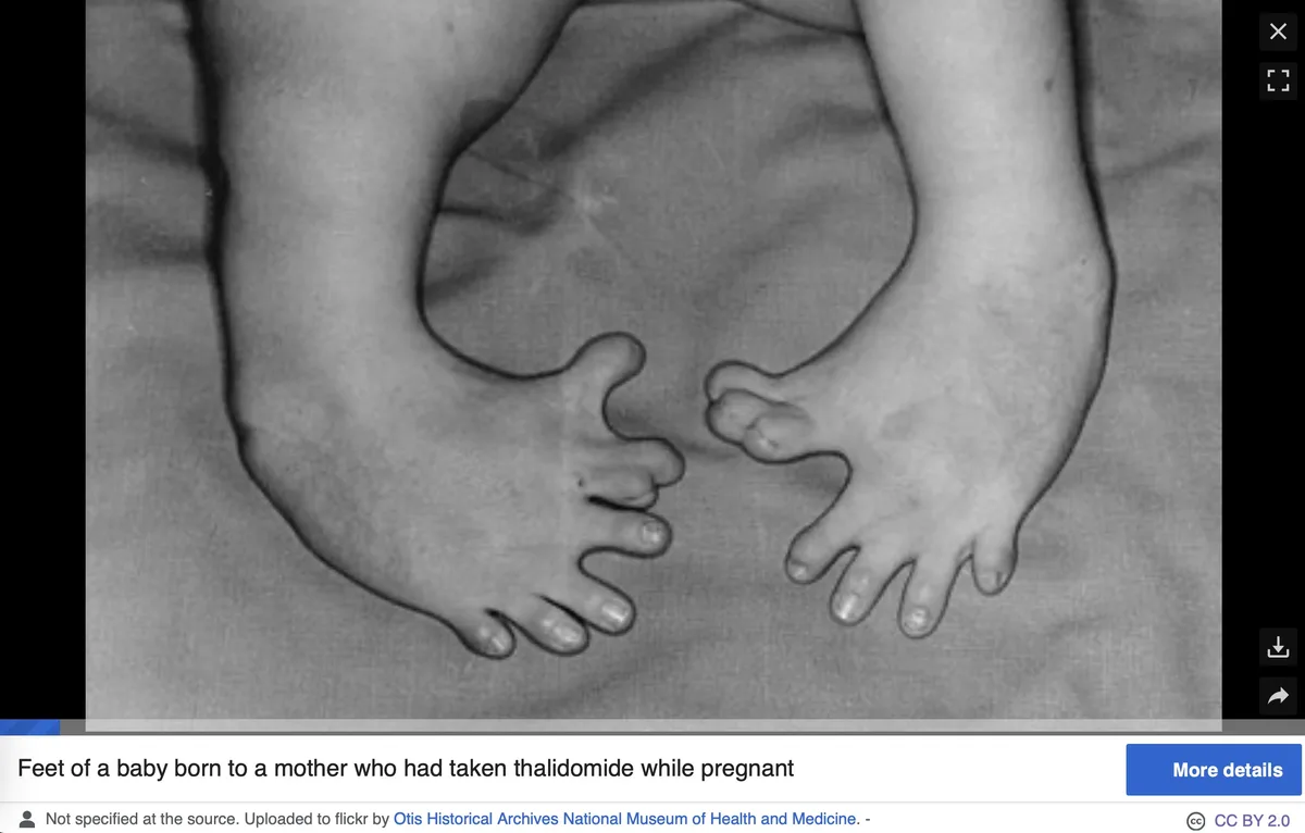 A black-and-white medical photograph shows the feet of a baby, with visible deformities in the toes, overlaid with the text…