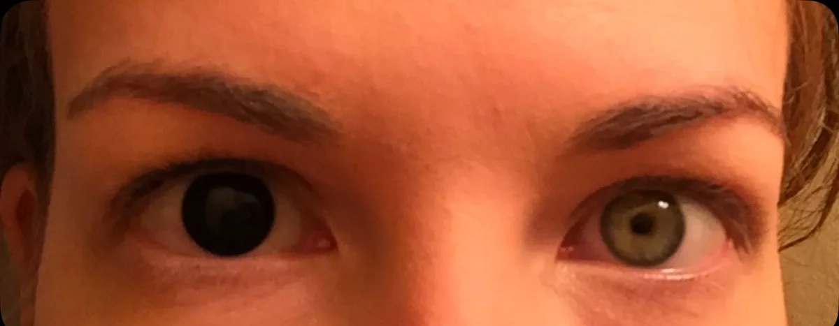 A close-up photo shows a person's face with one eye appearing black and the other eye appearing green, creating a striking…