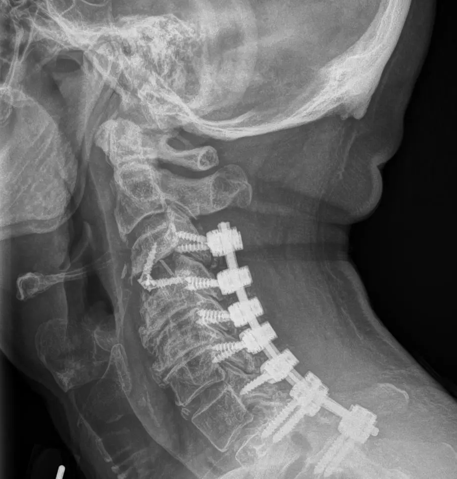 An x-ray image shows a person's cervical spine with multiple surgical screws and rods fused together for stabilization. The…