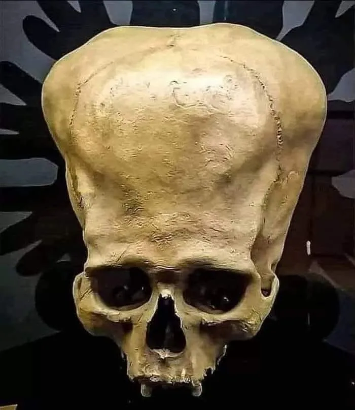 a close-up photograph of a human skull with an unusually large, rounded, and bulbous cranium, displayed against a dark…