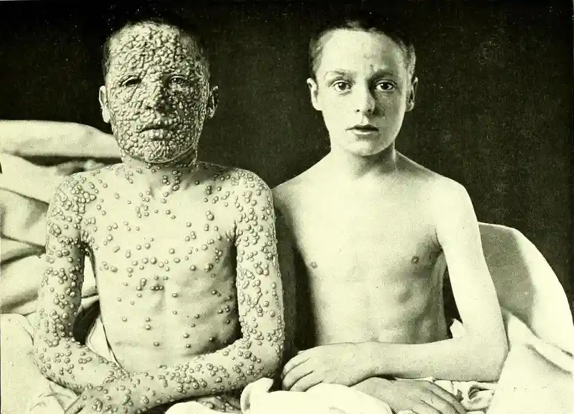 A vintage black-and-white photo shows two young boys sitting side by side; the boy on the left has severe, widespread…