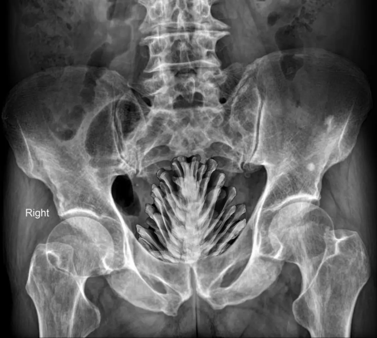 An x-ray image of a human pelvis showing the skeletal structure, including the hip bones and spine, with the word 'Right'…