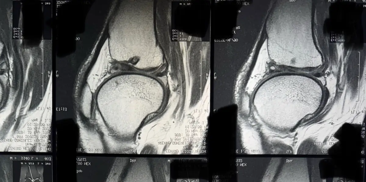 The image displays a medical scan, specifically an MRI of a knee joint, showing multiple grayscale cross-sectional views…