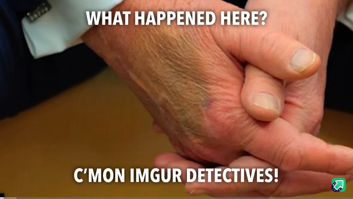 A close-up image shows an older person's hand being held by another person's hand, with visible wrinkles and a small bruise…