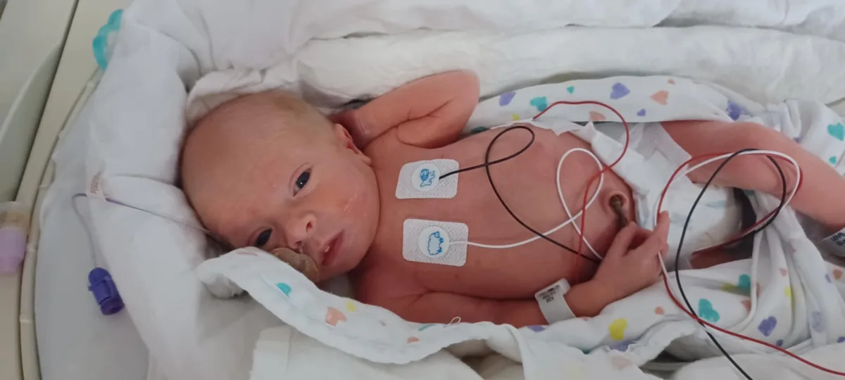 A newborn baby in a hospital bed, connected to medical monitors with wires and electrodes on its chest, has a nasal cannula…