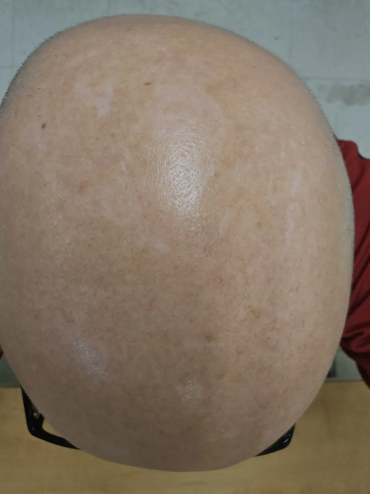 A close-up, top-down photo shows the bare, rounded scalp of a person with very little hair, wearing black-rimmed glasses…