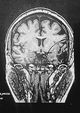 A black-and-white medical MRI scan of a human brain, showing detailed brain structures with a dark circular outline…