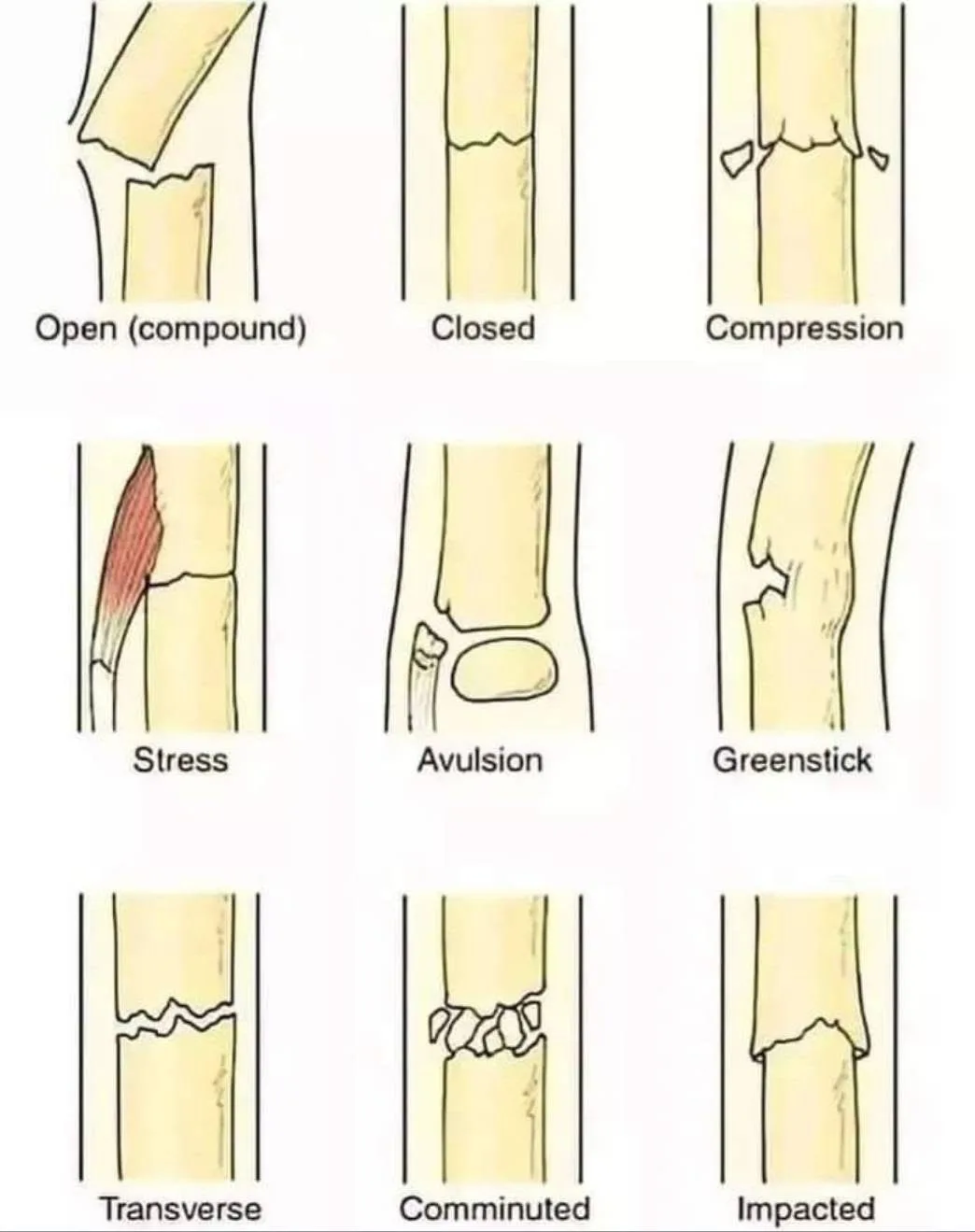 The image displays a medical diagram illustrating nine different types of bone fractures, each labeled with its specific…