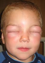 A close-up photo of a young child with fair skin and short blond hair, eyes tightly shut with flushed cheeks, wearing a blue…