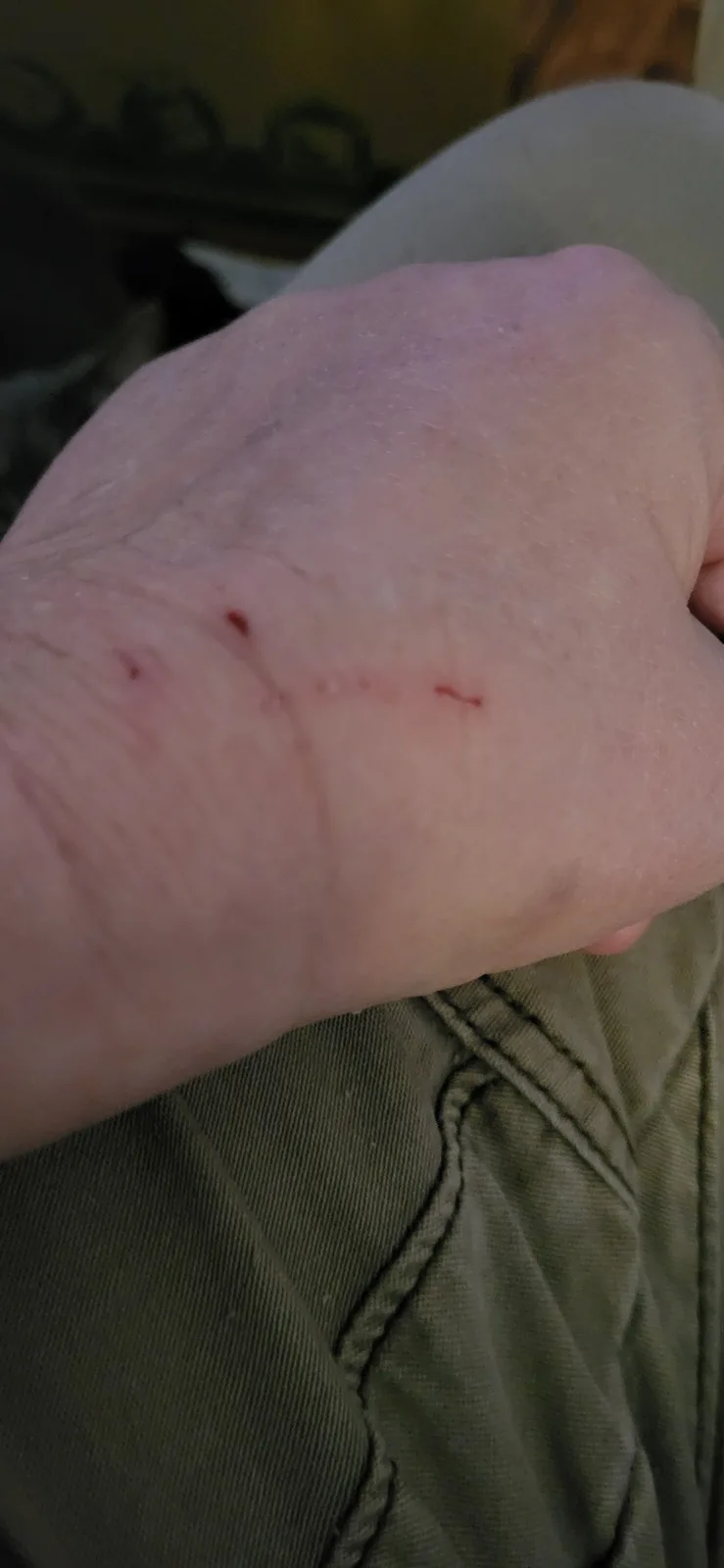 A close-up photo shows a person's hand resting on their knee, with a small, shallow scratch visible on the back of the hand…