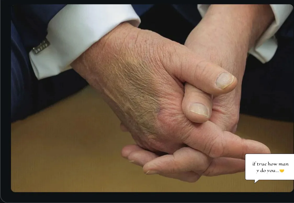 A close-up image shows two hands clasped together, one visibly older and wrinkled with a dark bruise on the back, while the…
