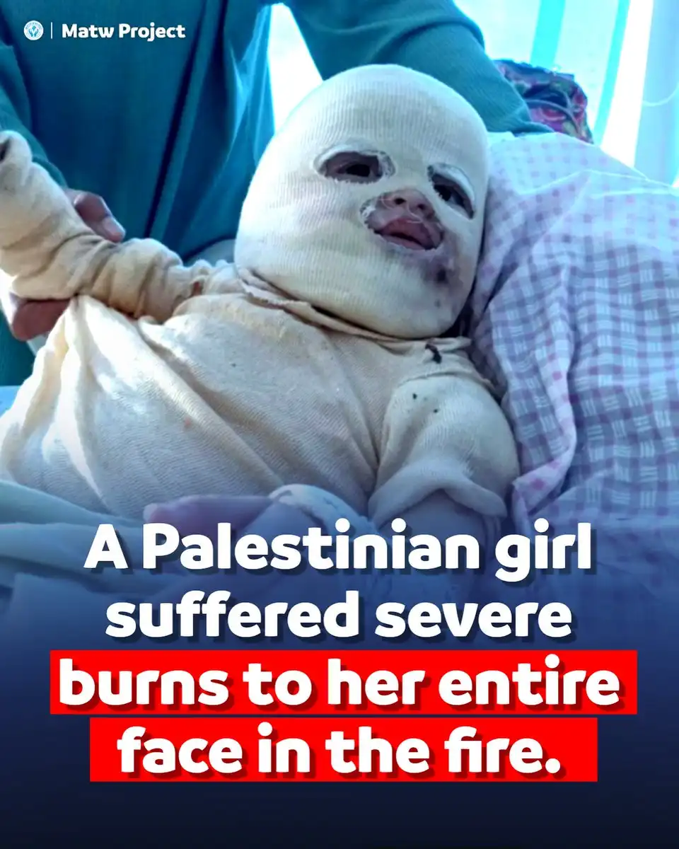 A baby with severe facial burns is wrapped in bandages, held by an adult in a medical setting. The overlaid text reads: 'A…