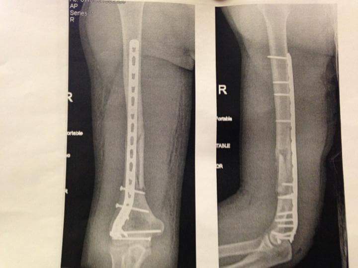 Two x-ray images side-by-side show a human leg with a metal plate and screws inserted into the femur. The left image…