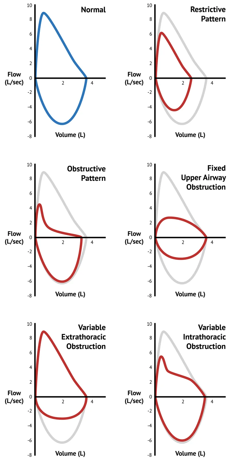 The image displays six flow-volume loop graphs comparing normal lung function with various obstructive and restrictive…